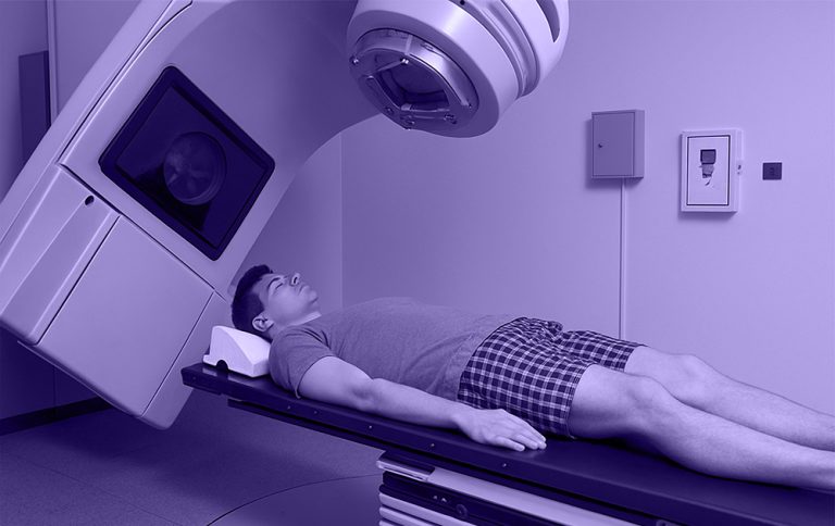 Toxicités tardives après radiothérapie du cancer de la prostate